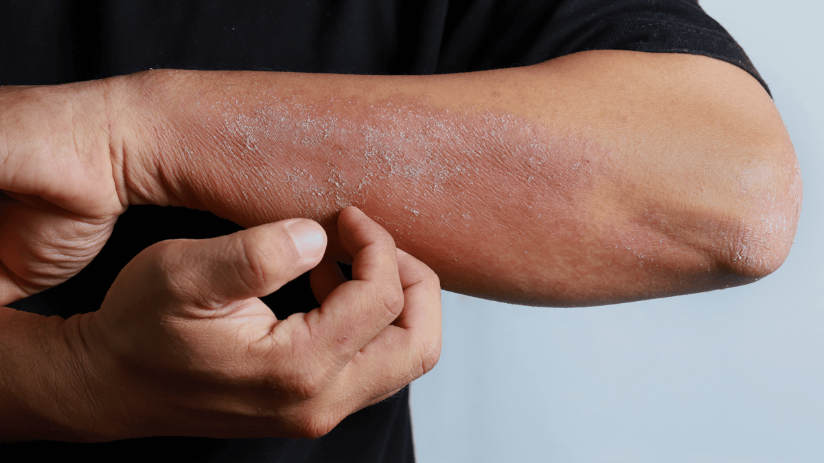 male worker with allergies
