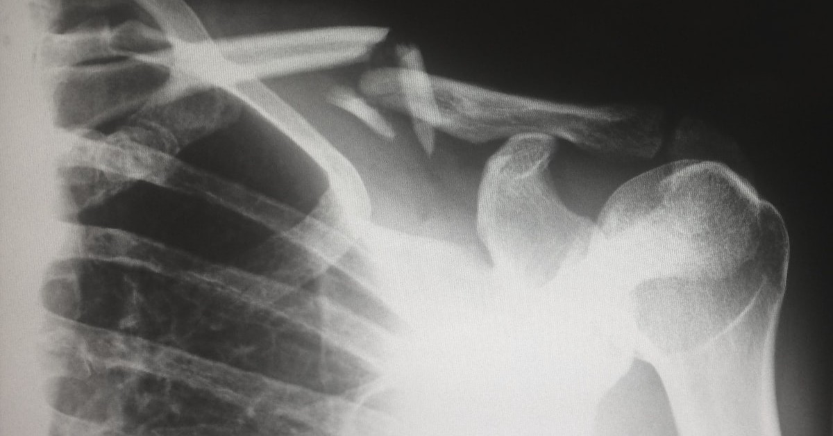 xray of a workplace injury